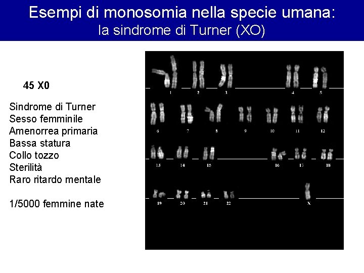 Esempi di monosomia nella specie umana: la sindrome di Turner (XO) 45 X 0 Esempi di monosomia nella specie umana: la sindrome di Turner (XO) 45 X 0