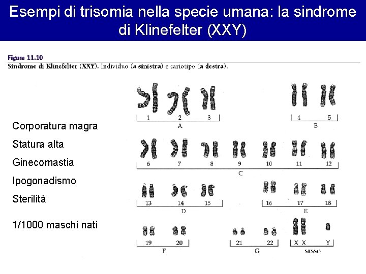 Esempi di trisomia nella specie umana: la sindrome di Klinefelter (XXY) Corporatura magra Statura Esempi di trisomia nella specie umana: la sindrome di Klinefelter (XXY) Corporatura magra Statura