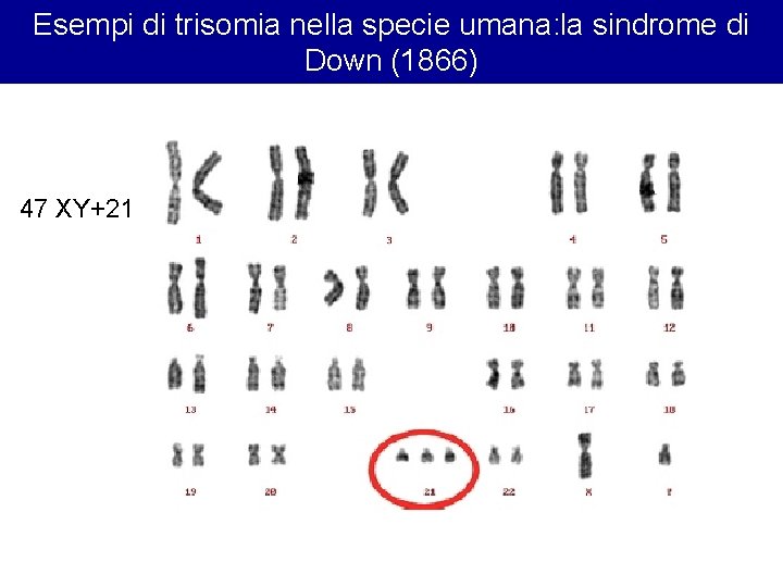 Esempi di trisomia nella specie umana: la sindrome di Down (1866) 47 XY+21 Esempi di trisomia nella specie umana: la sindrome di Down (1866) 47 XY+21