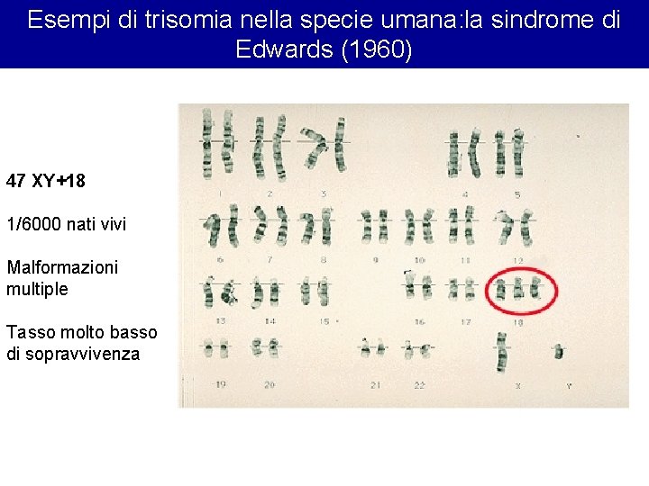 Esempi di trisomia nella specie umana: la sindrome di Edwards (1960) 47 XY+18 1/6000 Esempi di trisomia nella specie umana: la sindrome di Edwards (1960) 47 XY+18 1/6000