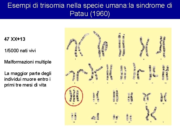 Esempi di trisomia nella specie umana: la sindrome di Patau (1960) 47 XX+13 1/5000 Esempi di trisomia nella specie umana: la sindrome di Patau (1960) 47 XX+13 1/5000