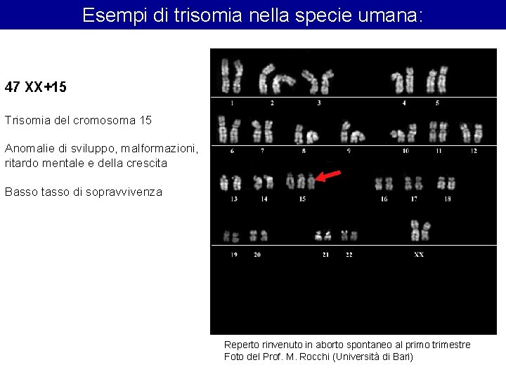 Esempi di trisomia nella specie umana: 47 XX+15 Trisomia del cromosoma 15 Anomalie di Esempi di trisomia nella specie umana: 47 XX+15 Trisomia del cromosoma 15 Anomalie di
