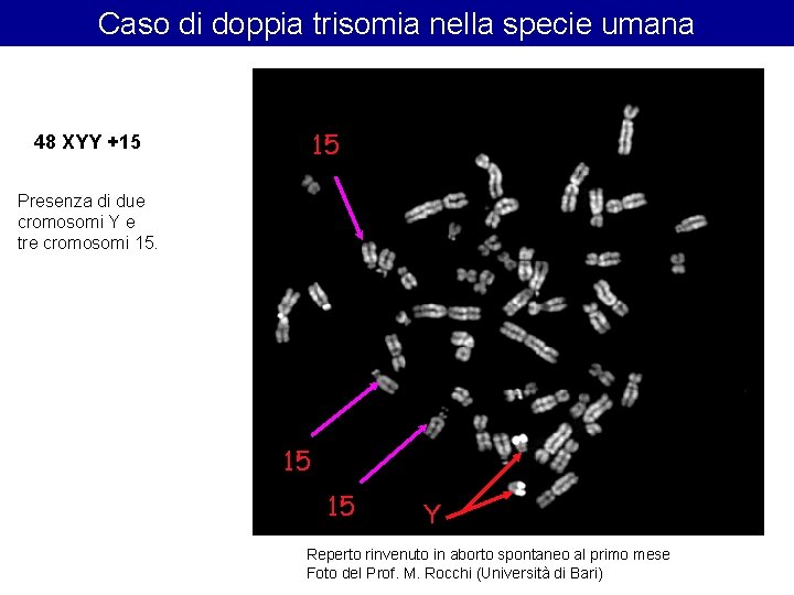 Caso di doppia trisomia nella specie umana 15 48 XYY +15 Presenza di due Caso di doppia trisomia nella specie umana 15 48 XYY +15 Presenza di due