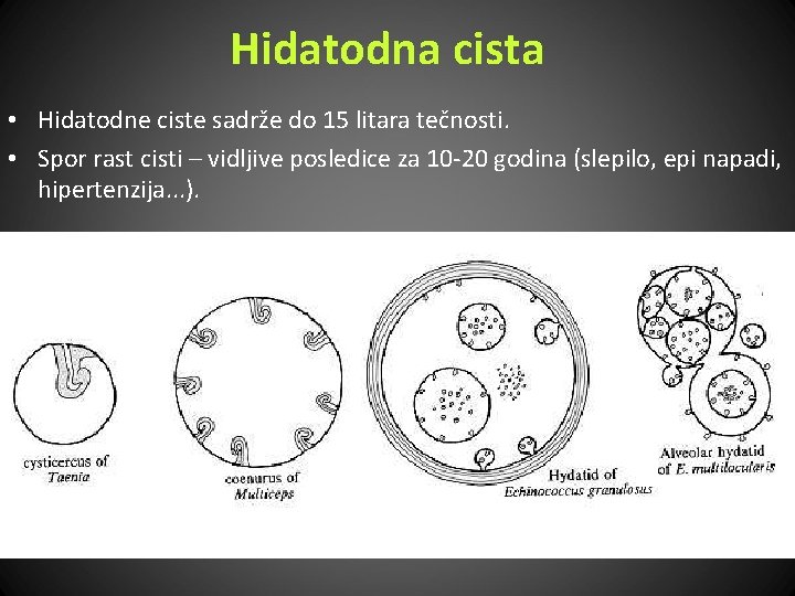 Hidatodna cista • Hidatodne ciste sadrže do 15 litara tečnosti. • Spor rast cisti