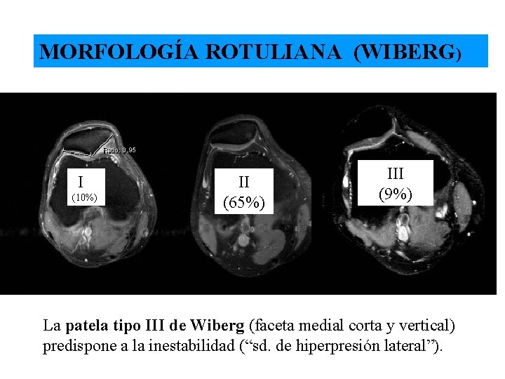 MORFOLOGÍA ROTULIANA (WIBERG) II II (65%) (10%) III (9%) 1 La patela tipo III