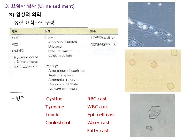 3. 요침사 검사 (Urine sediment) 3) 임상적 의의 - 정상 요침사의 구성 - 병적