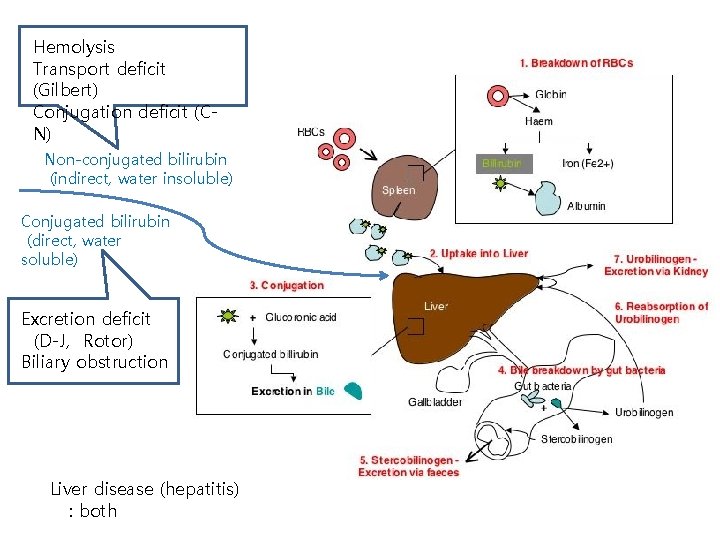 Hemolysis H Transport deficit (Gilbert) Conjugation deficit (CN) Non-conjugated bilirubin (indirect, water insoluble) Conjugated