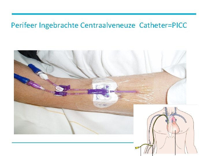 Perifeer Ingebrachte Centraalveneuze Catheter=PICC 