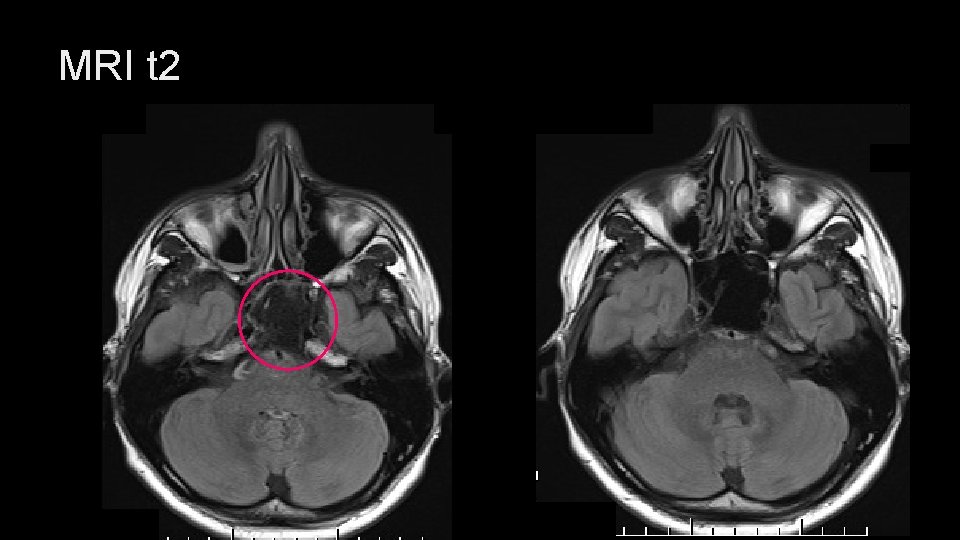 MRI t 2 