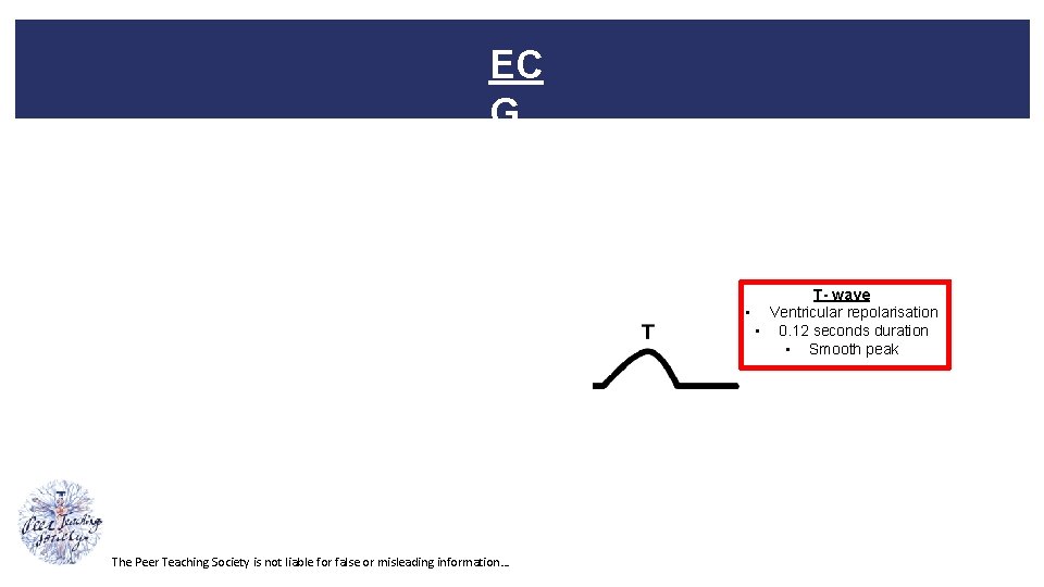 EC G T- wave • Ventricular repolarisation • 0. 12 seconds duration • Smooth