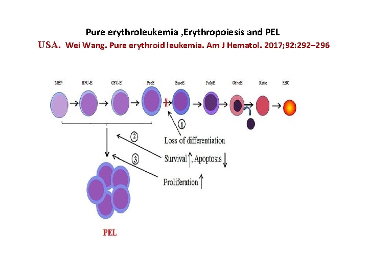 Pure erythroleukemia , Erythropoiesis and PEL USA. Wei Wang. Pure erythroid leukemia. Am J