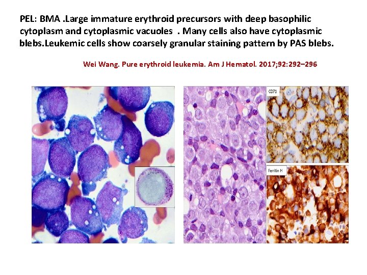 PEL: BMA. Large immature erythroid precursors with deep basophilic cytoplasm and cytoplasmic vacuoles. Many