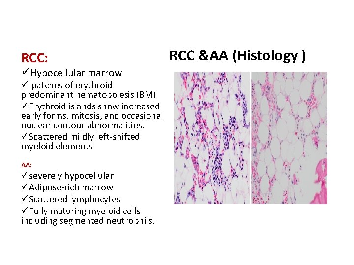  RCC: üHypocellular marrow ü patches of erythroid predominant hematopoiesis (BM) üErythroid islands show