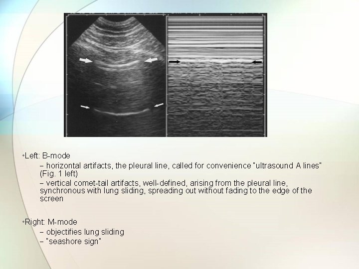  • Left: B-mode − horizontal artifacts, the pleural line, called for convenience “ultrasound