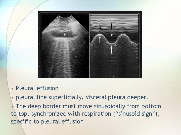  • Pleural effusion • pleural line superficially, visceral pleura deeper. • The deep