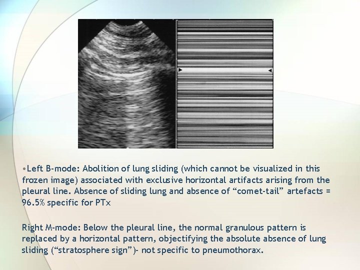  • Left B-mode: Abolition of lung sliding (which cannot be visualized in this