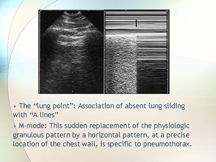  • The “lung point”: Association of absent lung sliding with “A lines” •