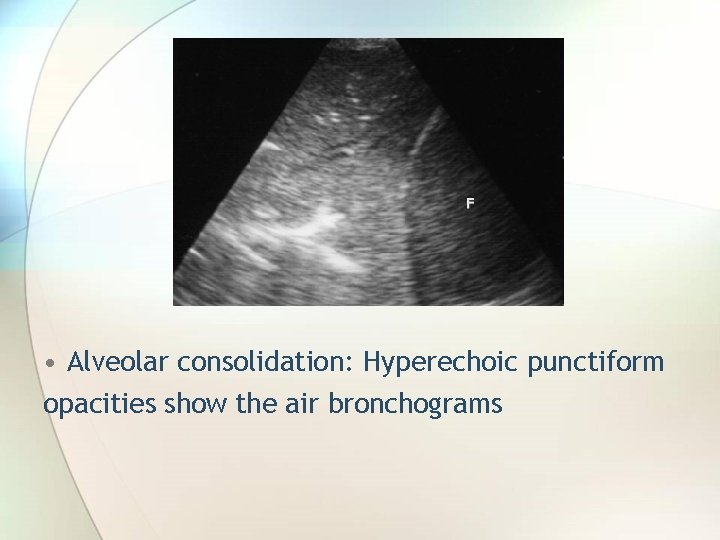  • Alveolar consolidation: Hyperechoic punctiform opacities show the air bronchograms 