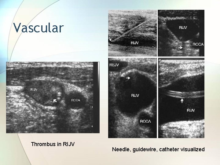 Vascular Thrombus in RIJV Needle, guidewire, catheter visualized 