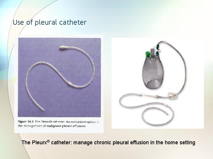 Use of pleural catheter The Pleurx® catheter: manage chronic pleural effusion in the home