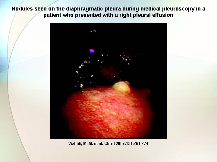 Nodules seen on the diaphragmatic pleura during medical pleuroscopy in a patient who presented