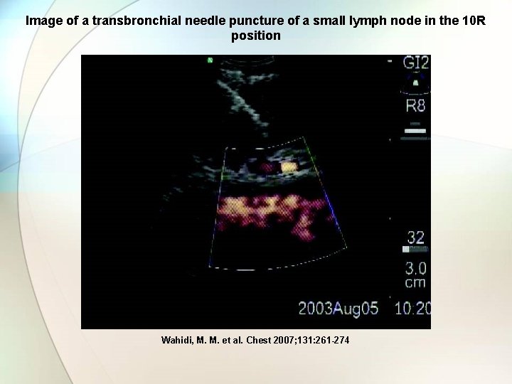 Image of a transbronchial needle puncture of a small lymph node in the 10