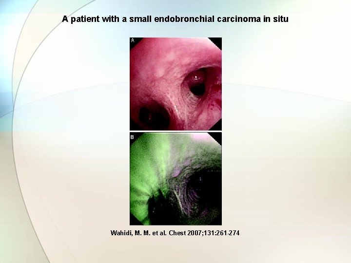 A patient with a small endobronchial carcinoma in situ Wahidi, M. M. et al.