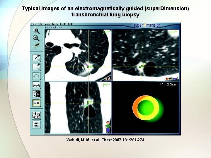 Typical images of an electromagnetically guided (super. Dimension) transbronchial lung biopsy Wahidi, M. M.