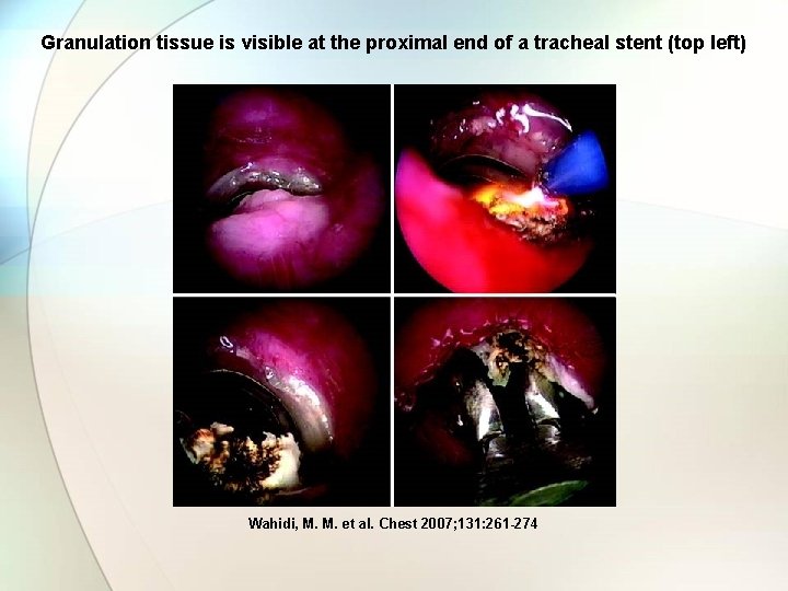 Granulation tissue is visible at the proximal end of a tracheal stent (top left)