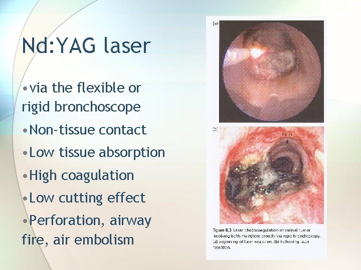Nd: YAG laser • via the flexible or rigid bronchoscope • Non-tissue contact •