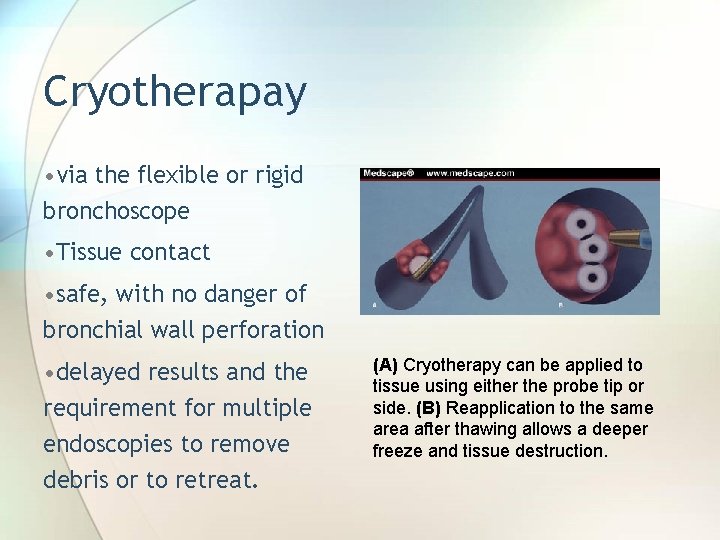 Cryotherapay • via the flexible or rigid bronchoscope • Tissue contact • safe, with