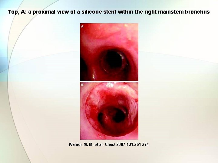 Top, A: a proximal view of a silicone stent within the right mainstem bronchus