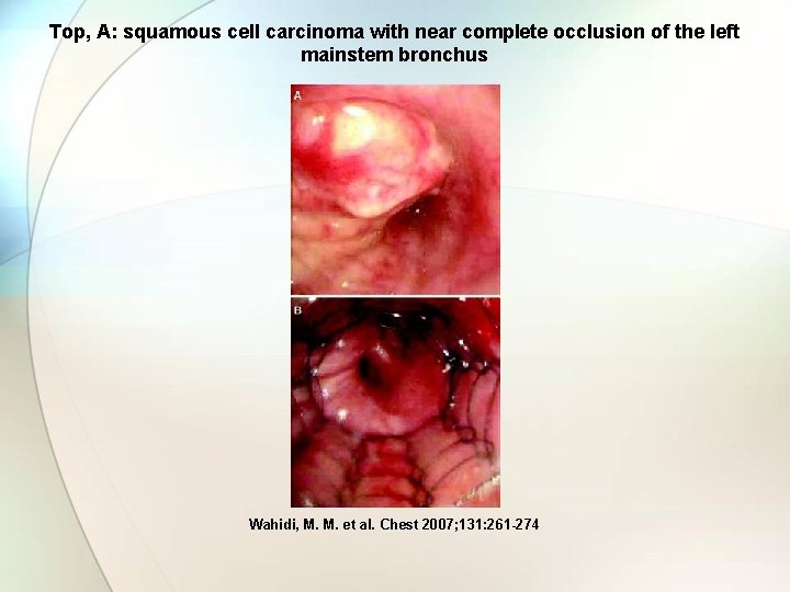 Top, A: squamous cell carcinoma with near complete occlusion of the left mainstem bronchus