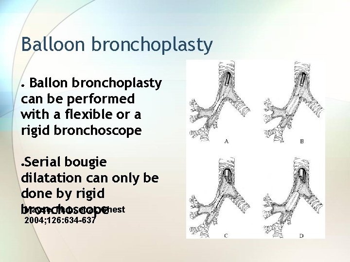 Balloon bronchoplasty Ballon bronchoplasty can be performed with a flexible or a rigid bronchoscope