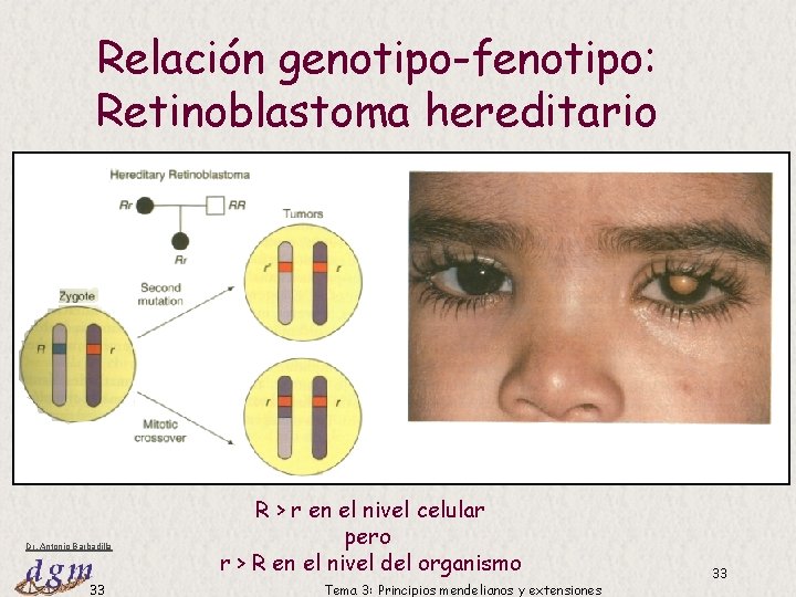 Relación genotipo-fenotipo: Retinoblastoma hereditario Dr. Antonio Barbadilla 33 R > r en el nivel Relación genotipo-fenotipo: Retinoblastoma hereditario Dr. Antonio Barbadilla 33 R > r en el nivel