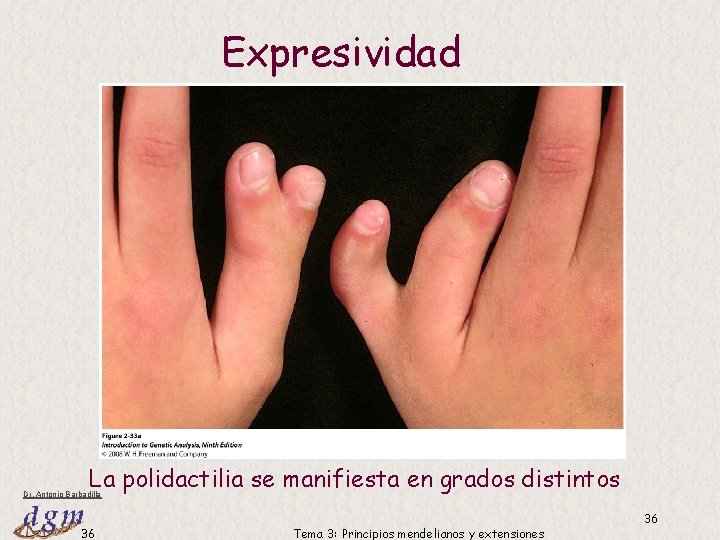 Expresividad La polidactilia se manifiesta en grados distintos Dr. Antonio Barbadilla 36 Tema 3: Expresividad La polidactilia se manifiesta en grados distintos Dr. Antonio Barbadilla 36 Tema 3: