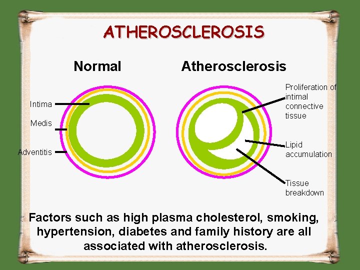 ATHEROSCLEROSIS Normal Intima Medis Adventitis Atherosclerosis Proliferation of intimal connective tissue Lipid accumulation Tissue