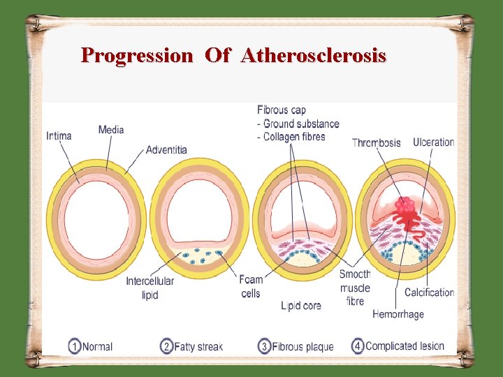 Progression Of Atherosclerosis 