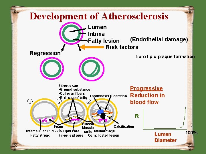 Development of Atherosclerosis Regression Lumen Intima (Endothelial damage) Fatty lesion Risk factors fibro lipid