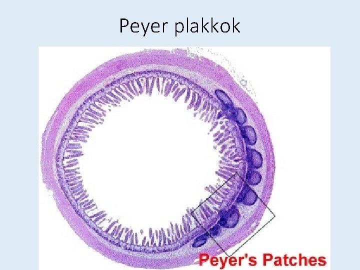 Peyer plakkok 