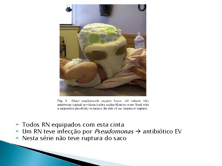 Todos RN equipados com esta cinta Um RN teve infecção por Pseudomonas antibiótico Todos RN equipados com esta cinta Um RN teve infecção por Pseudomonas antibiótico