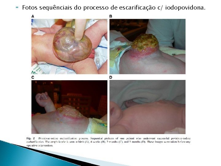 Fotos sequênciais do processo de escarificação c/ iodopovidona. Fotos sequênciais do processo de escarificação c/ iodopovidona.