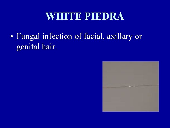 WHITE PIEDRA • Fungal infection of facial, axillary or genital hair. 