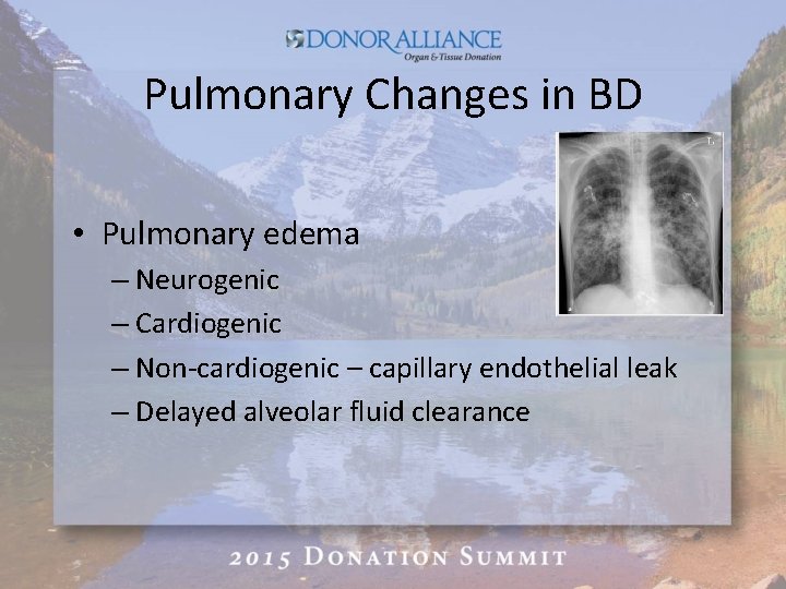 Pulmonary Changes in BD • Pulmonary edema – Neurogenic – Cardiogenic – Non-cardiogenic –