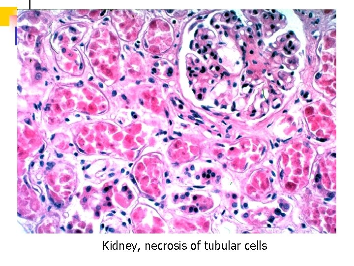 Kidney, necrosis of tubular cells Kidney, necrosis of tubular cells
