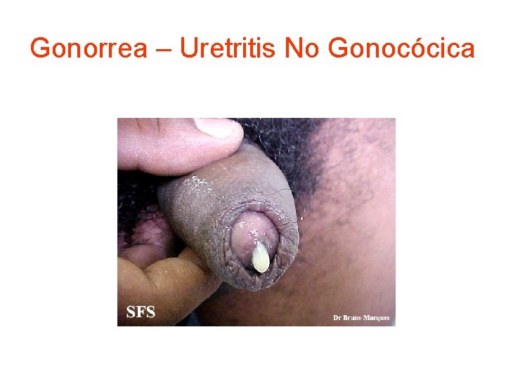 Gonorrea – Uretritis No Gonocócica 