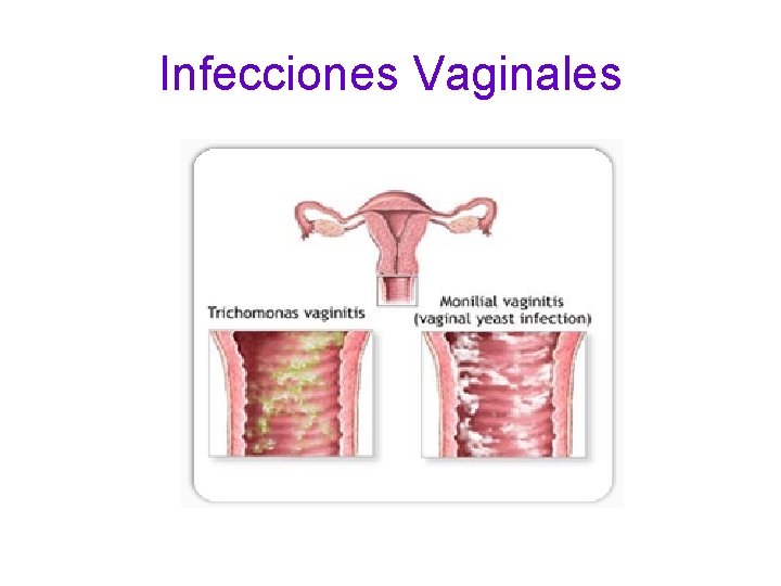 Infecciones Vaginales 