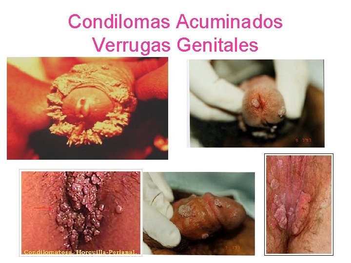 Condilomas Acuminados Verrugas Genitales 