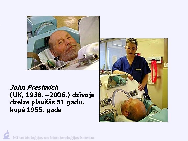 John Prestwich (UK, 1938. – 2006. ) dzīvoja dzelzs plaušās 51 gadu, kopš 1955.