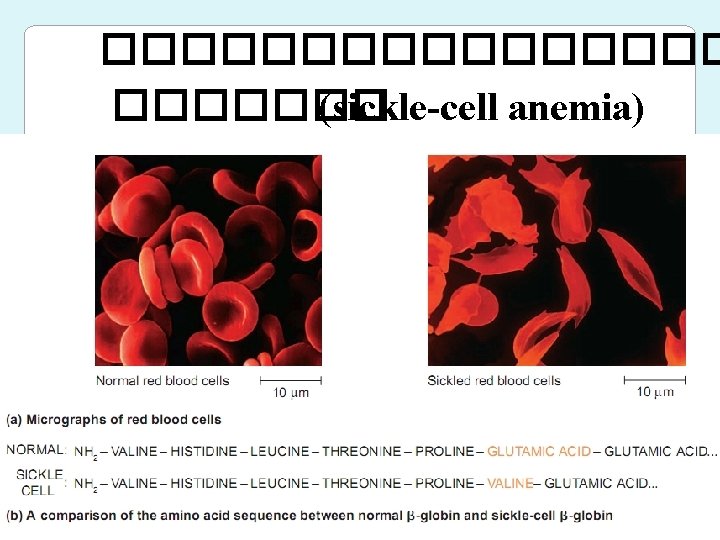 �������� (sickle-cell anemia) 